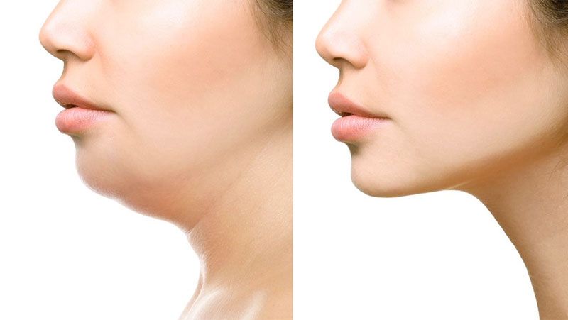 Como Evitar a Papada com dicas simples 1 Como Evitar a Papada com dicas simples